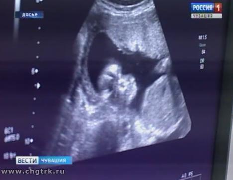 В этом году 650 супружеских пар Чувашии смогут пройти лечение от бесплодия методом ЭКО абсолютно бесплатно