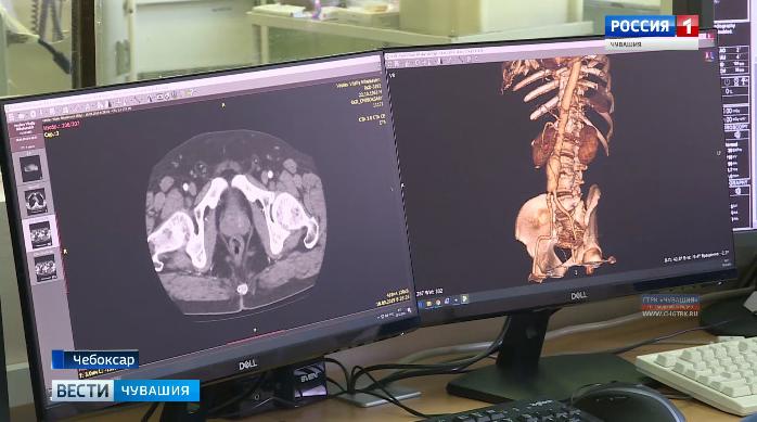 Кардиохирурги Республиканского диспансера впервые провели операцию на брюшной аорте
