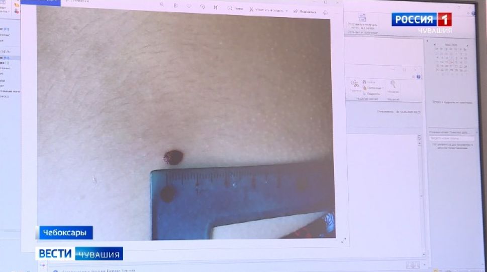 В Чебоксарах в онкодиспансере диагностируют меланому онлайн