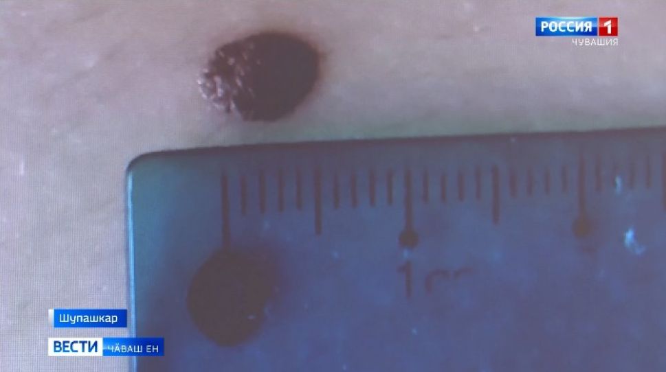 Диагноз - сӑн ӳкерчӗк тӑрӑх