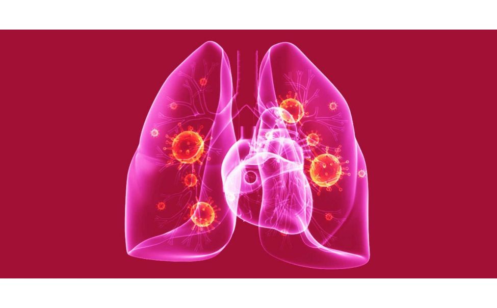 В Чувашии заболеваемость пневмонией выросла в разы