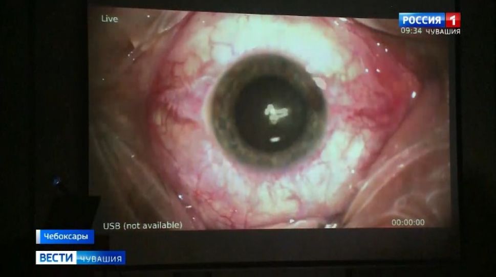 Офтальмологи рассказали о самых частых травмах глаз на новогодние праздники в Чувашии