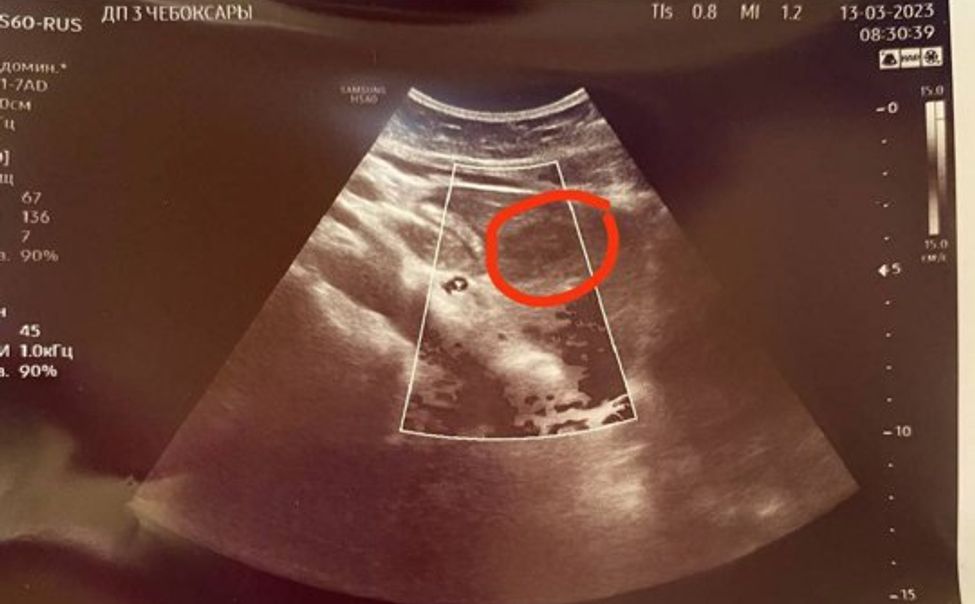 В Чебоксарах при диспансеризации у девочки-подростка обнаружили образование в печени