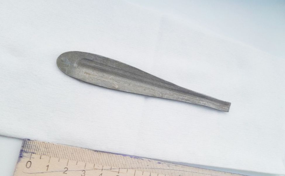 Житель Чувашии неделю проходил со столовой ложкой в желудке 