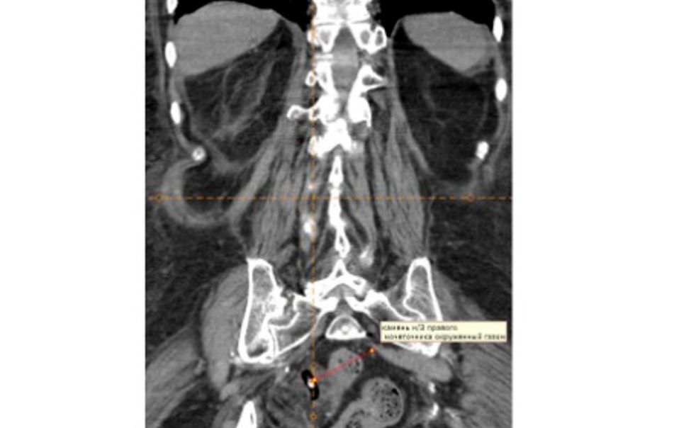 Врачи Новочебоксарской больницы столкнулись с редким заболеванием