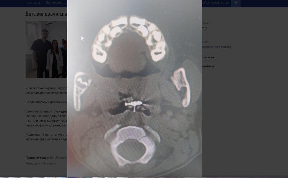 Чебоксарские врачи спасли 4-летнюю девочку, вдохнувшую заколку-"крабик"