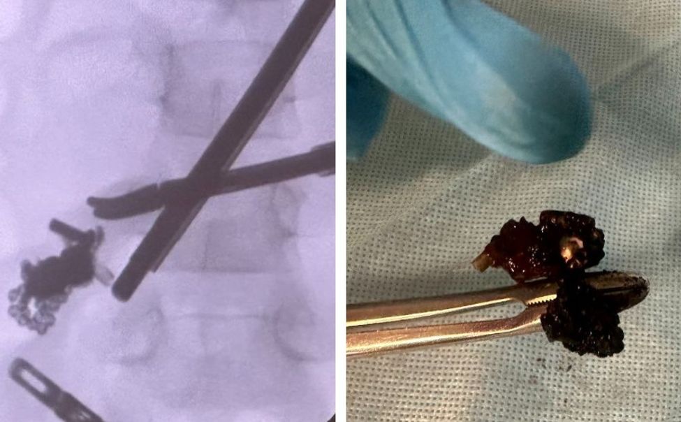 В Чувашии двое детей попали в больницу, проглотив магнитные шарики

