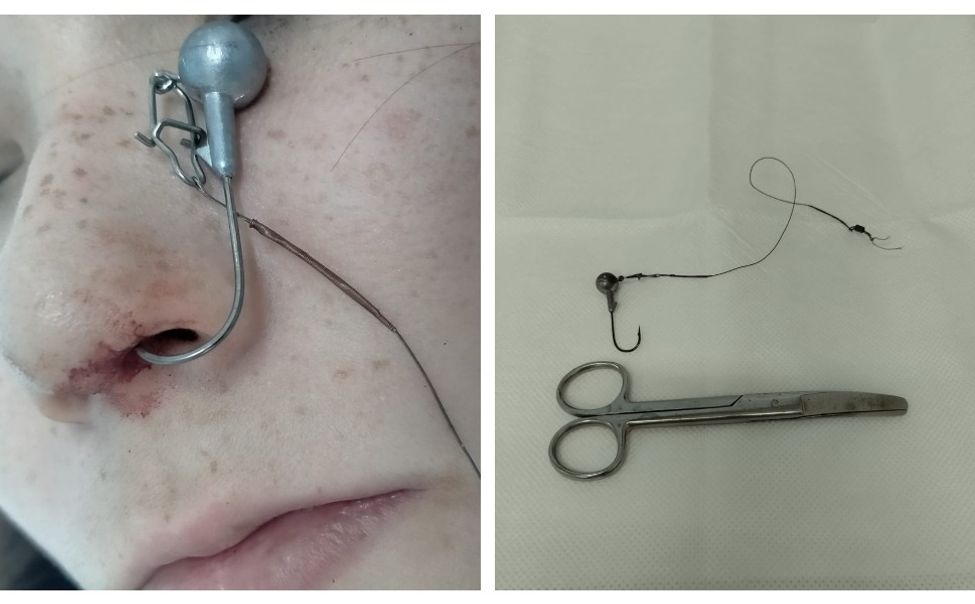 Житель Чувашии зацепил нос сестры рыболовным крючком