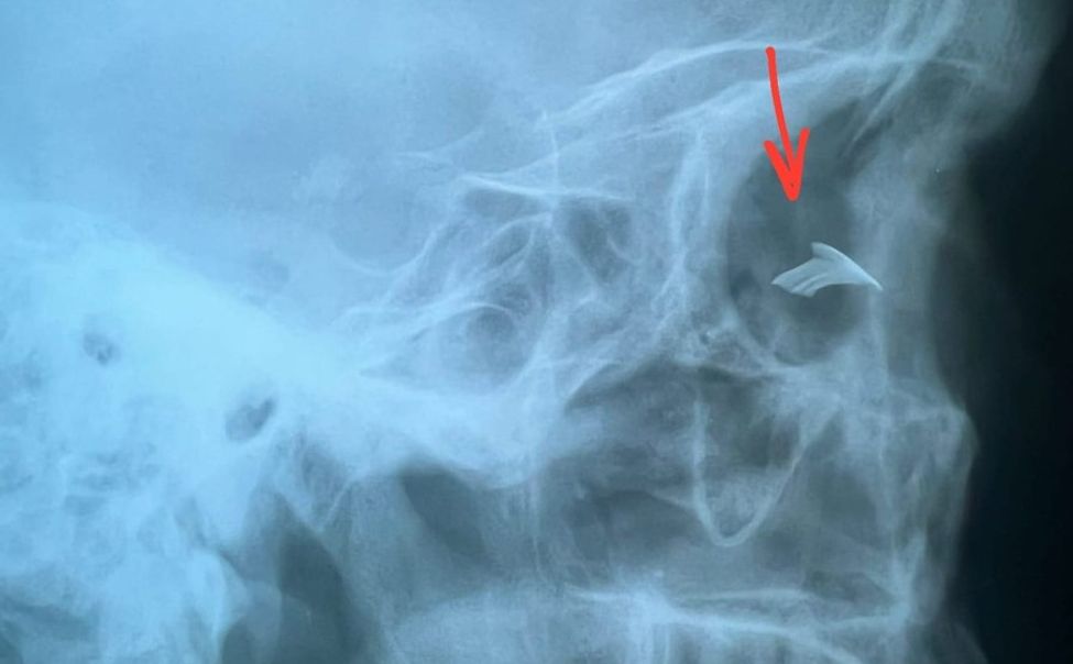 В Чебоксарах врачи спасли глаз мужчине после травмы при строительных работах