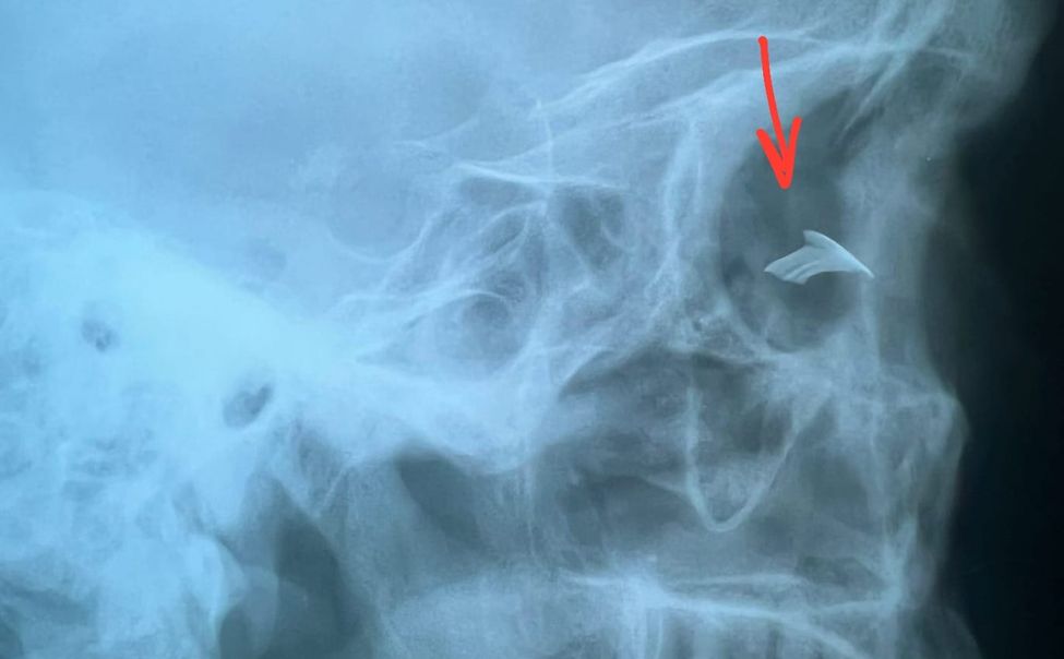 Чувашские офтальмологи извлекли из глаза мужчины металлический осколок