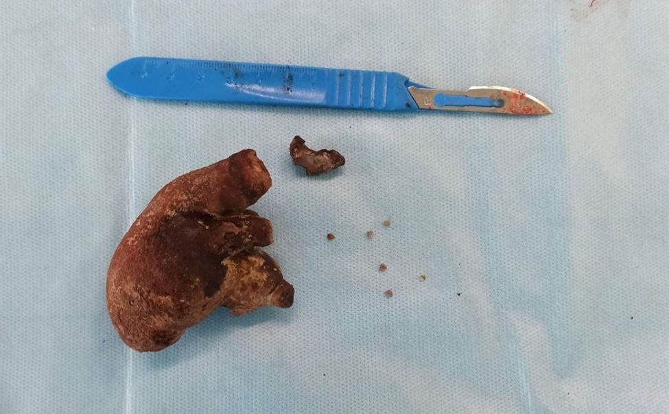 В Чувашии врачи спасли женщине почку, удалив камень размером 7 см