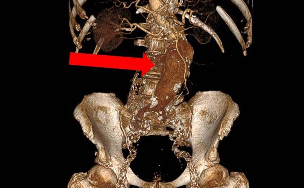 В Чувашии экстренные действия хирурга спасли от смерти пациента с разрывом аорты