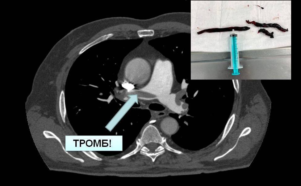 Хирурги извлекли из легочной артерии жителя Чувашии тромбы длиной более 10 см