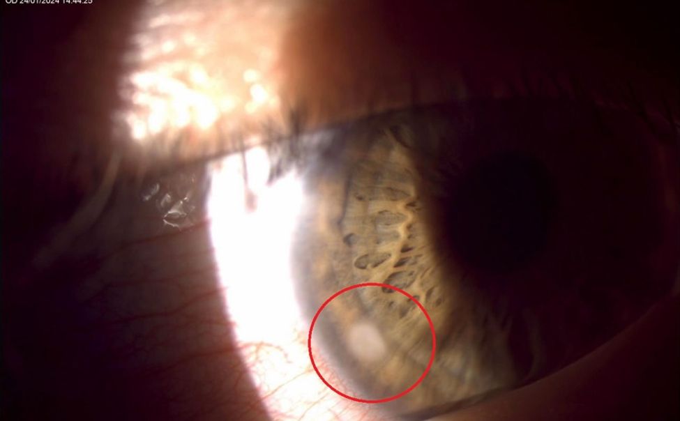 Житель Чувашии чуть не потерял зрение из-за линз