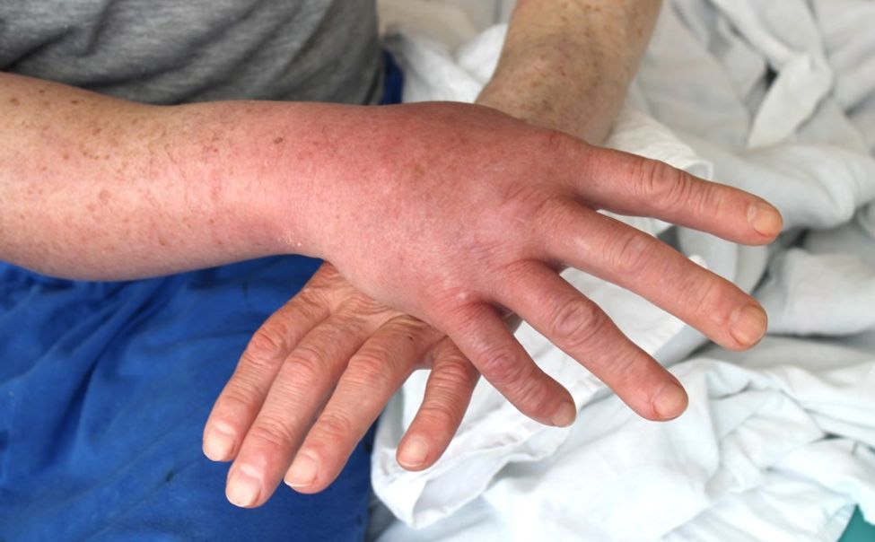 Чебоксарец попал в больницу после укуса гадюки