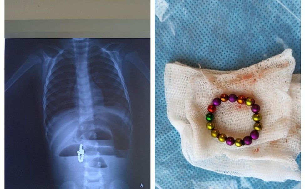 В Чувашии детские хирурги спасли детей, проглотивших магнитные шарики и бусы