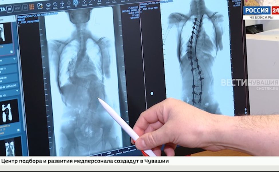 Чувашские врачи подарили девушке из Бердянска новую правильную осанку