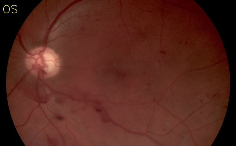 За февраль офтальмологи Чувашии выявили диабетическую ретинопатию у 89 пациентов