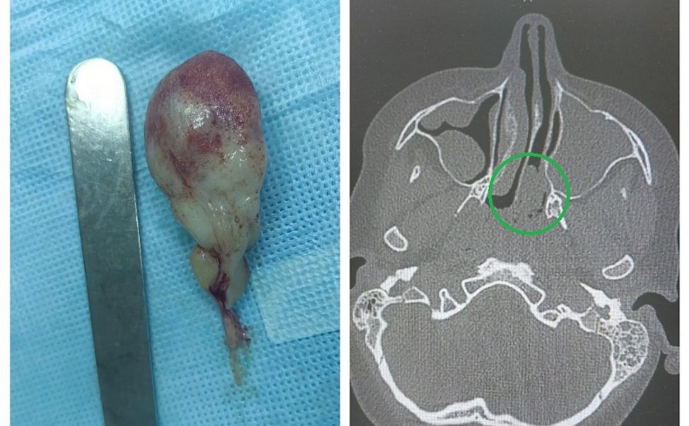 В Чебоксарах детские хирурги вернули мальчику способность дышать носом