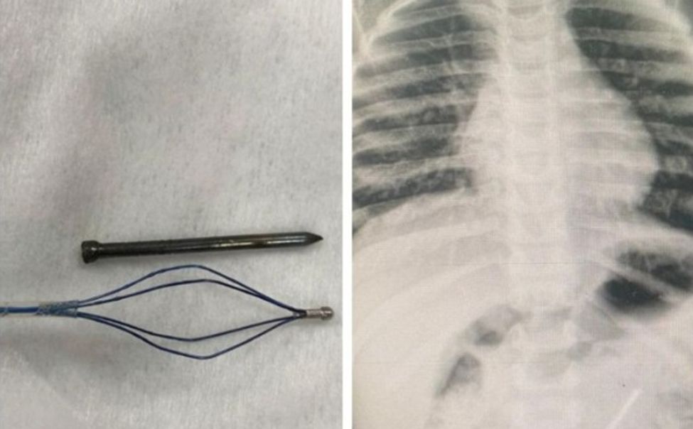 В Чувашии детские хирурги спасли мальчика, который проглотил гвозди