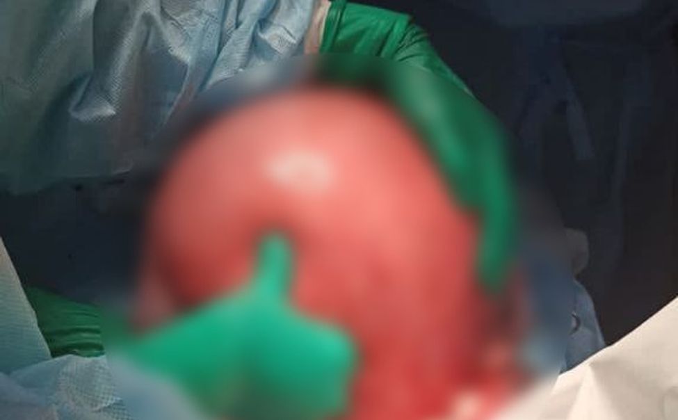 В Чебоксарах врачи удалили пациентке 10-килограммовую опухоль 