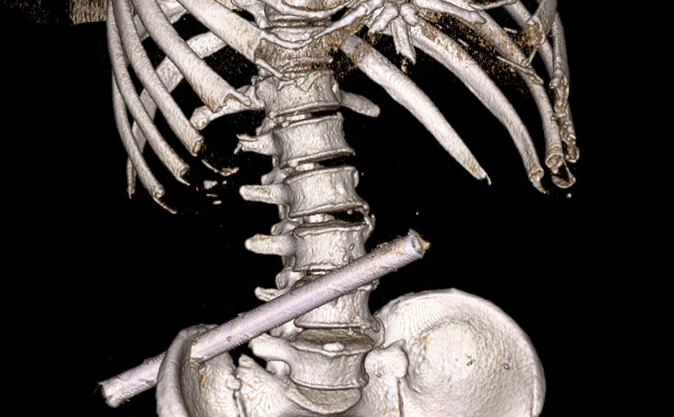 Новочебоксарские хирурги извлекли из пациента 25 сантиметровую трубу