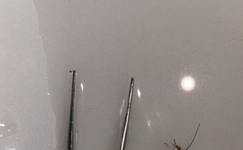 Чебоксарские специалисты извлекли антропода из уха девочки