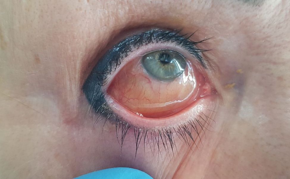 В Чебоксарах девушка после татуажа век получила химический ожог глаза