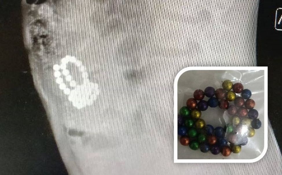 В Чебоксарах экстренно прооперировали малышей, проглотивших более 50-ти магнитных шариков